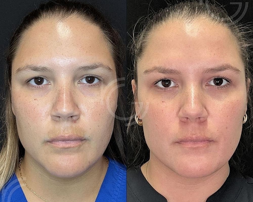 Patient Case Study: Transforming Sun-Damaged Skin & Melasma #1