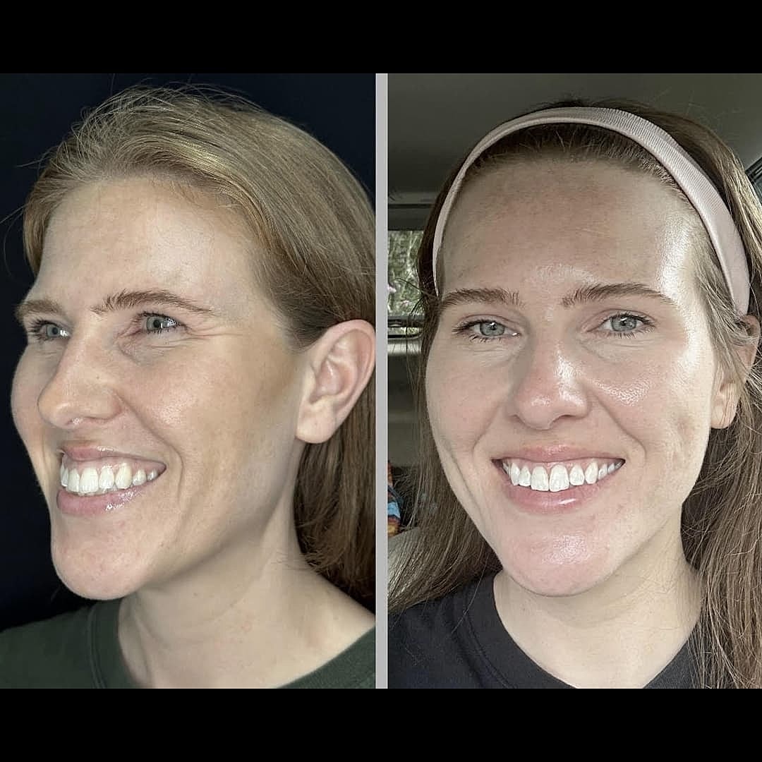 Patient Case Study: Transforming Sun-Damaged Skin & Melasma: 2
