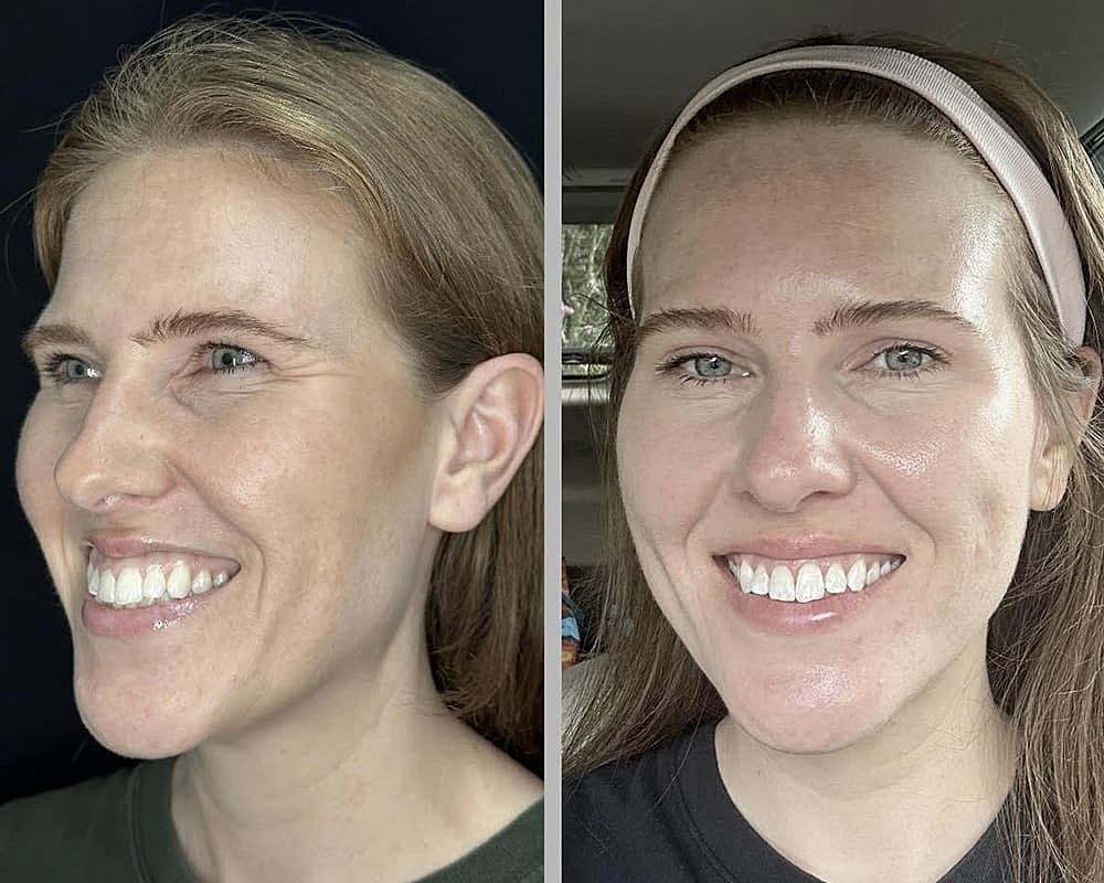 Patient Case Study: Transforming Sun-Damaged Skin & Melasma #2