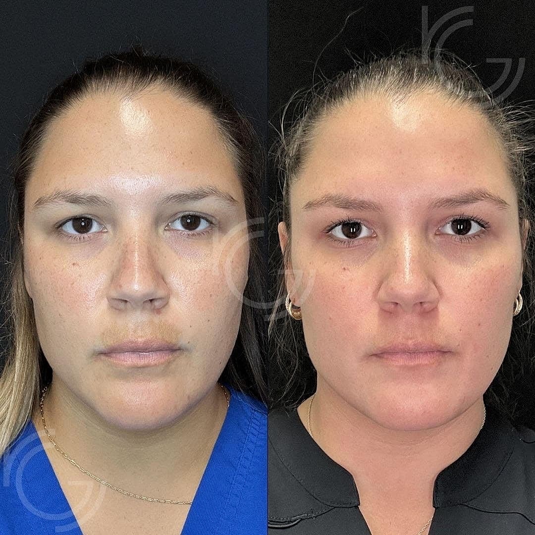 Patient Case Study: Transforming Sun-Damaged Skin & Melasma: 1
