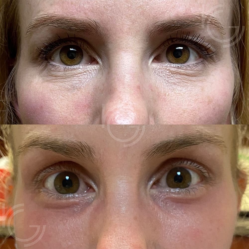 Laser Skin Resurfacing Before & After