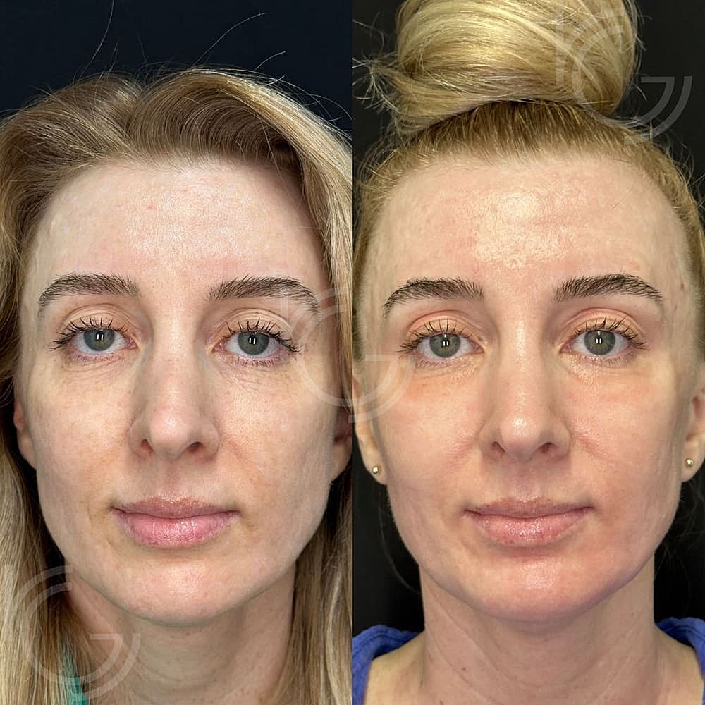 Laser Skin Resurfacing Before & After