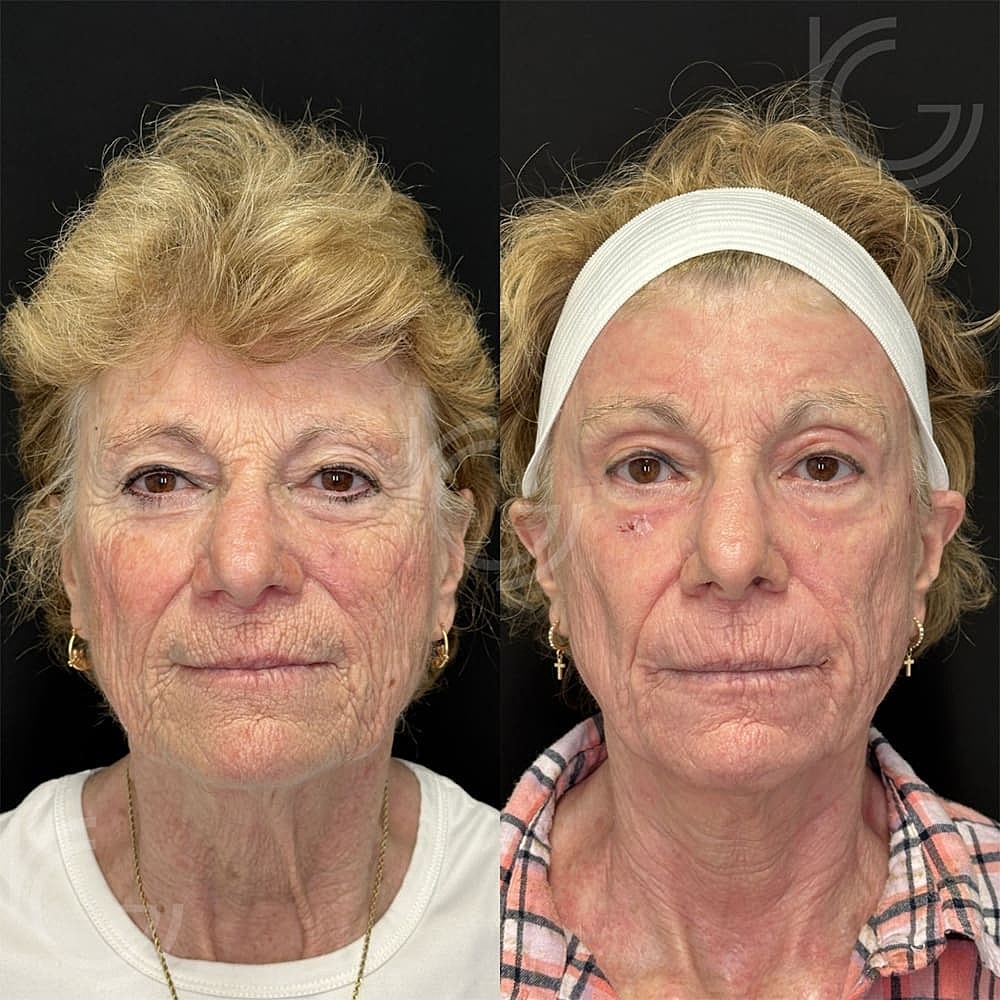 Laser Skin Resurfacing Before & After