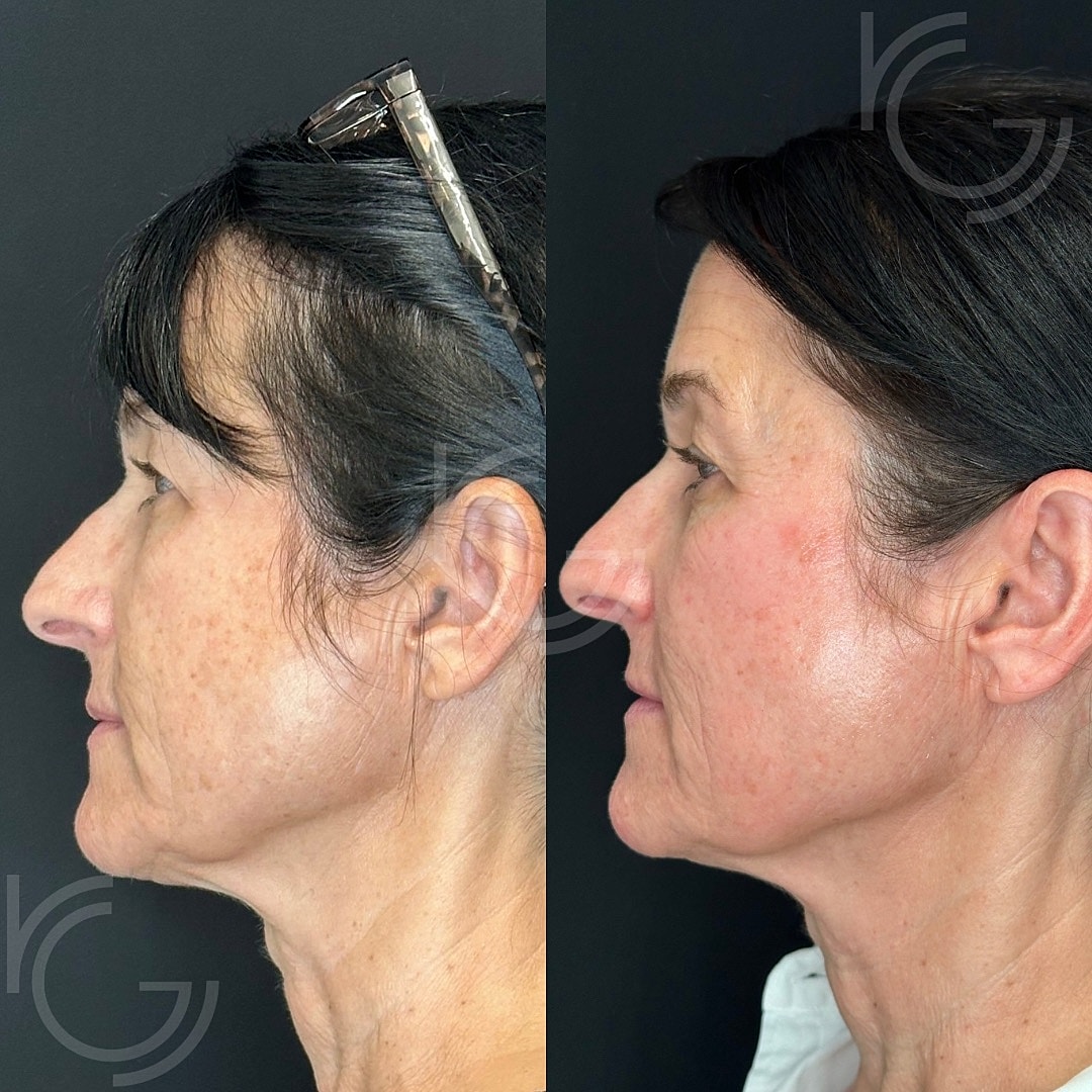 CoolPeel Before & After