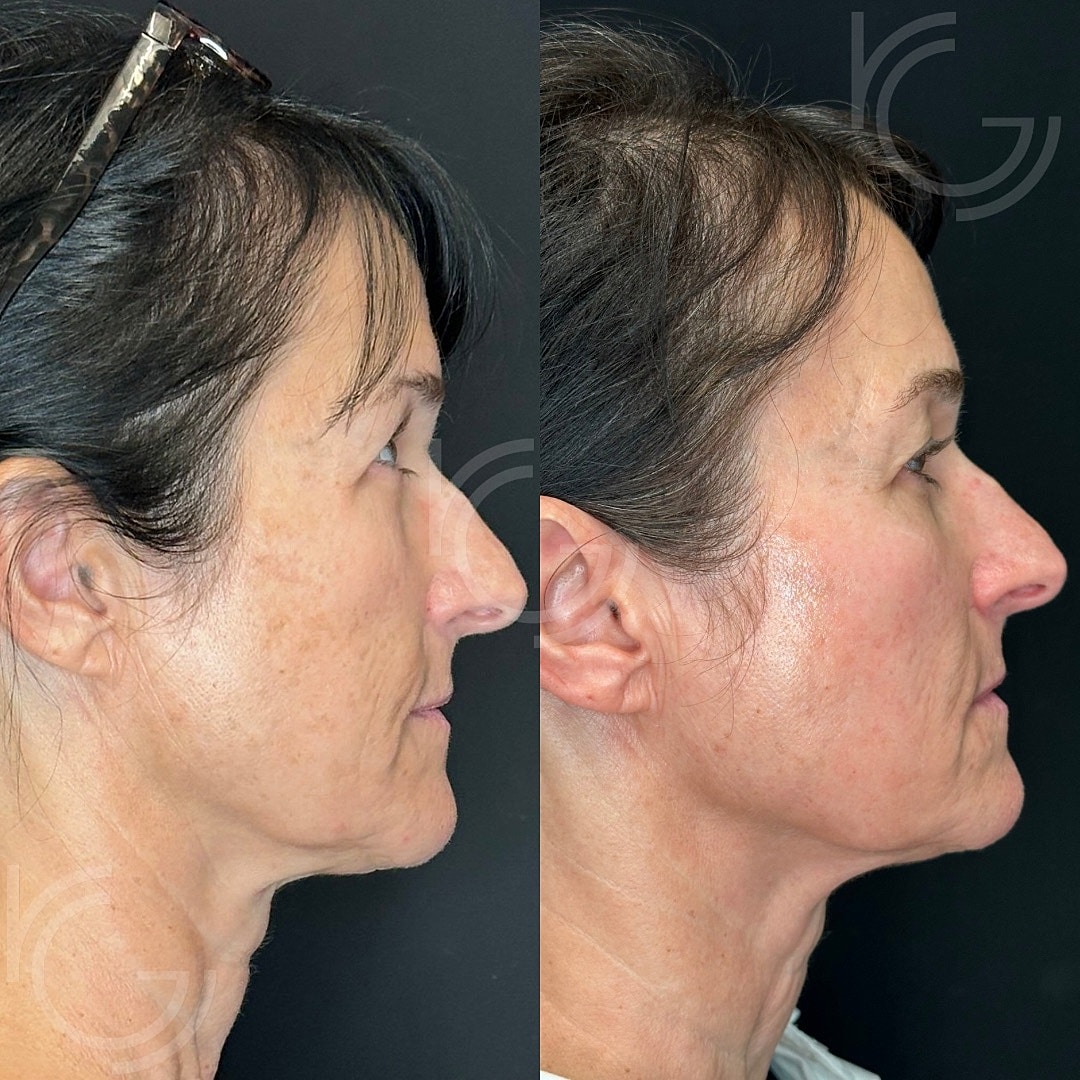 CoolPeel Before & After