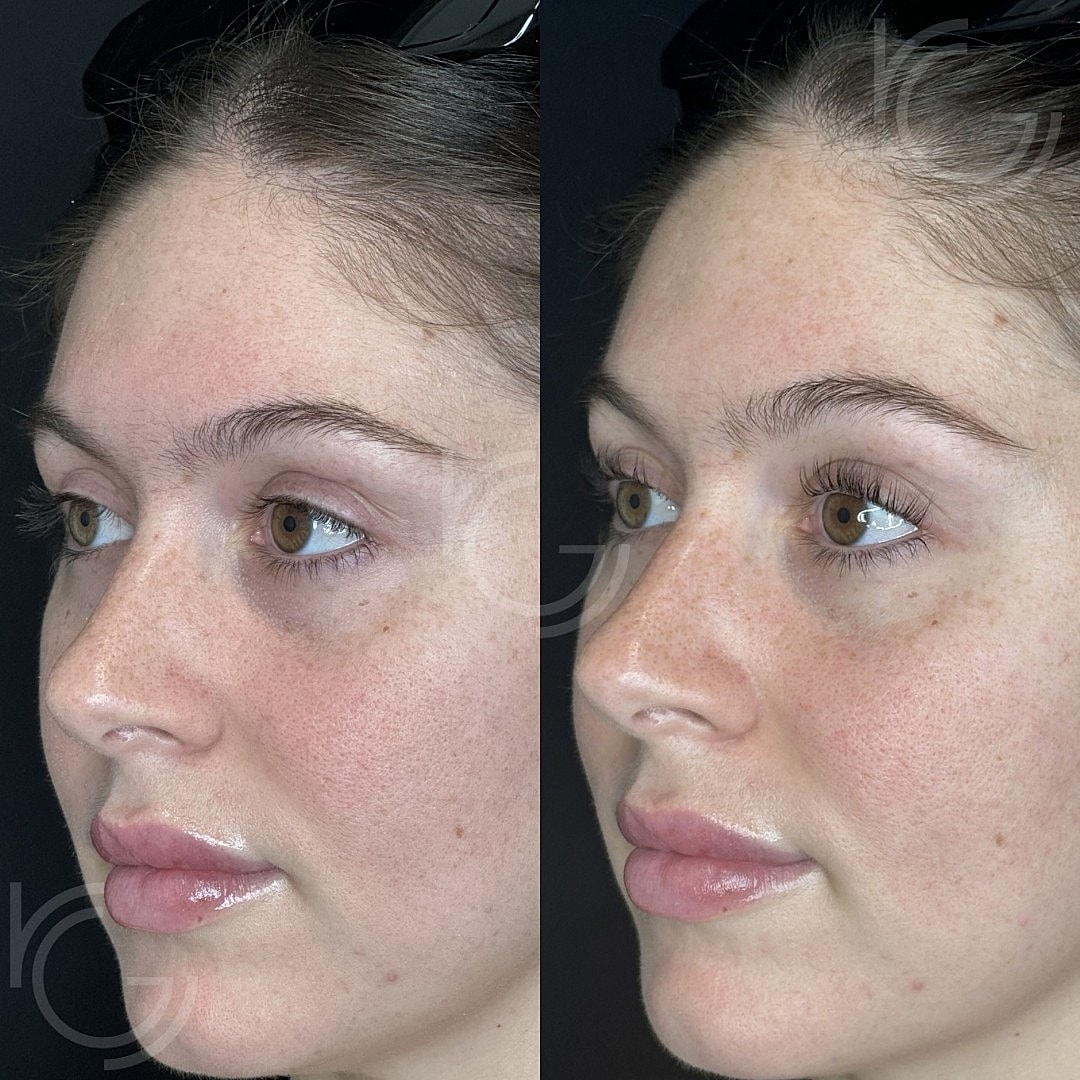 CoolPeel Before & After