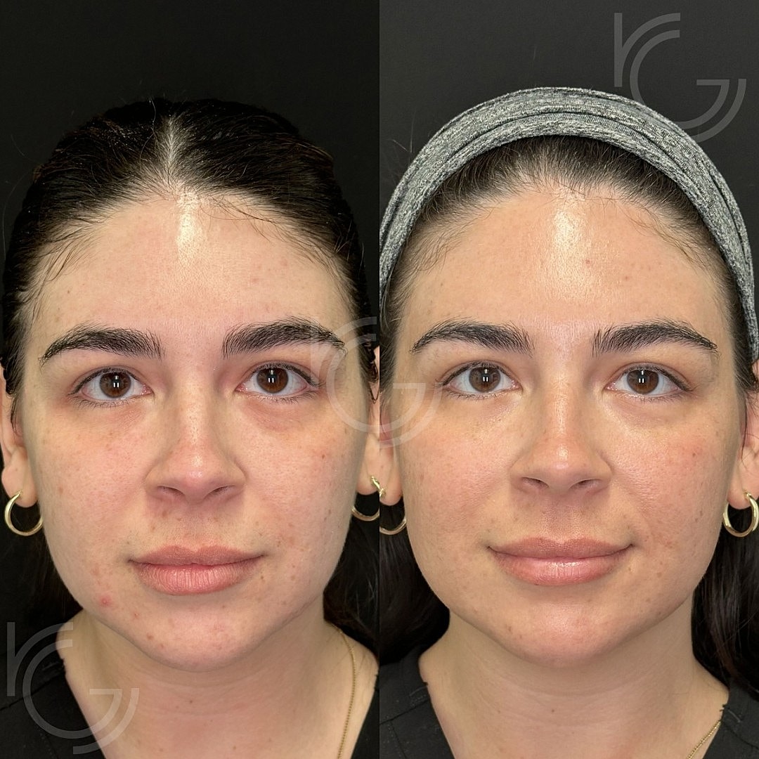 CoolPeel Before & After