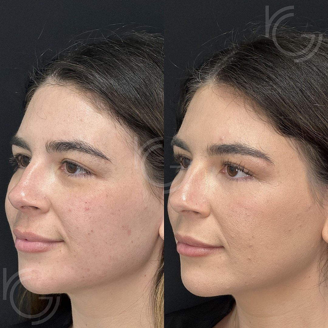CoolPeel Before & After