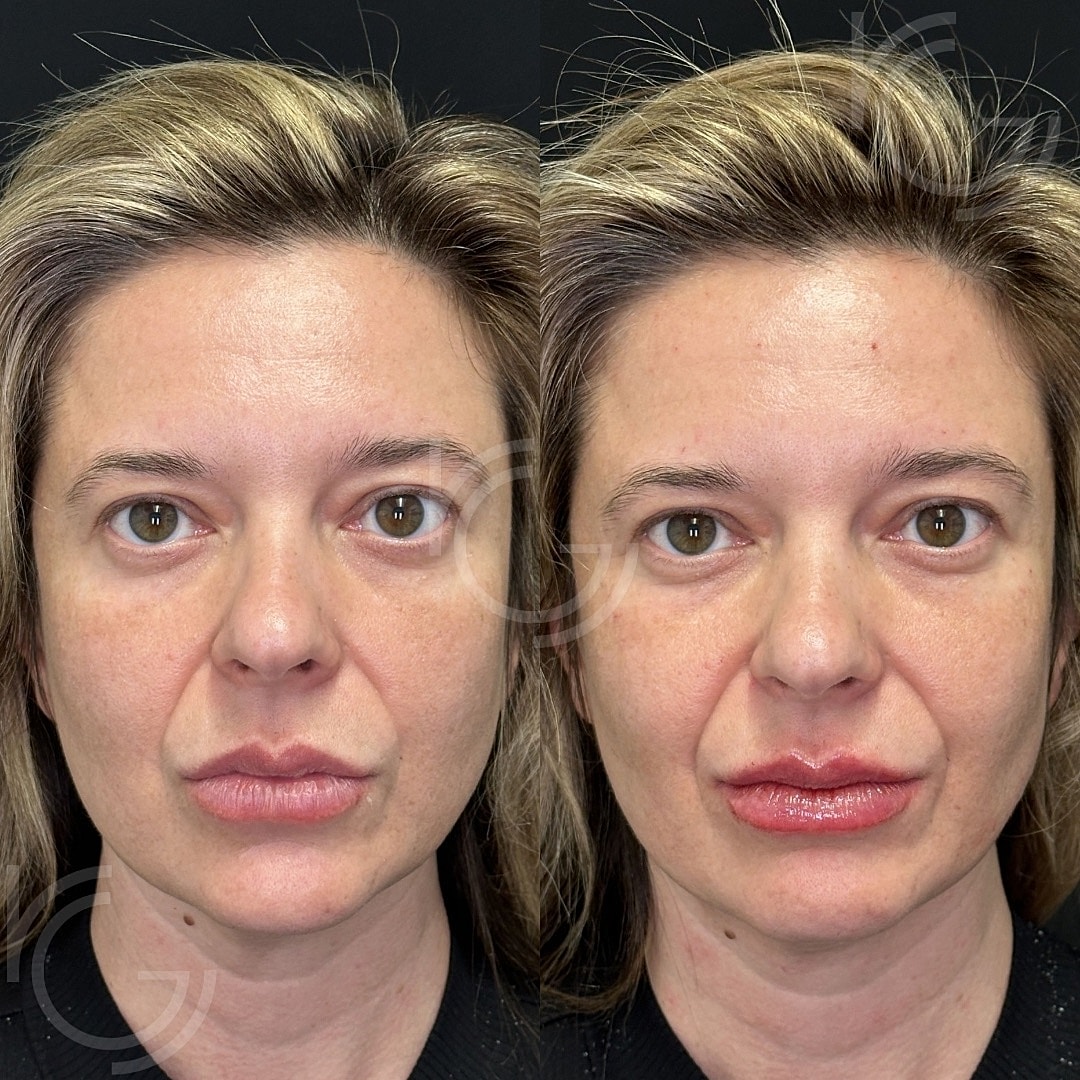 Lip Fillers Before & After