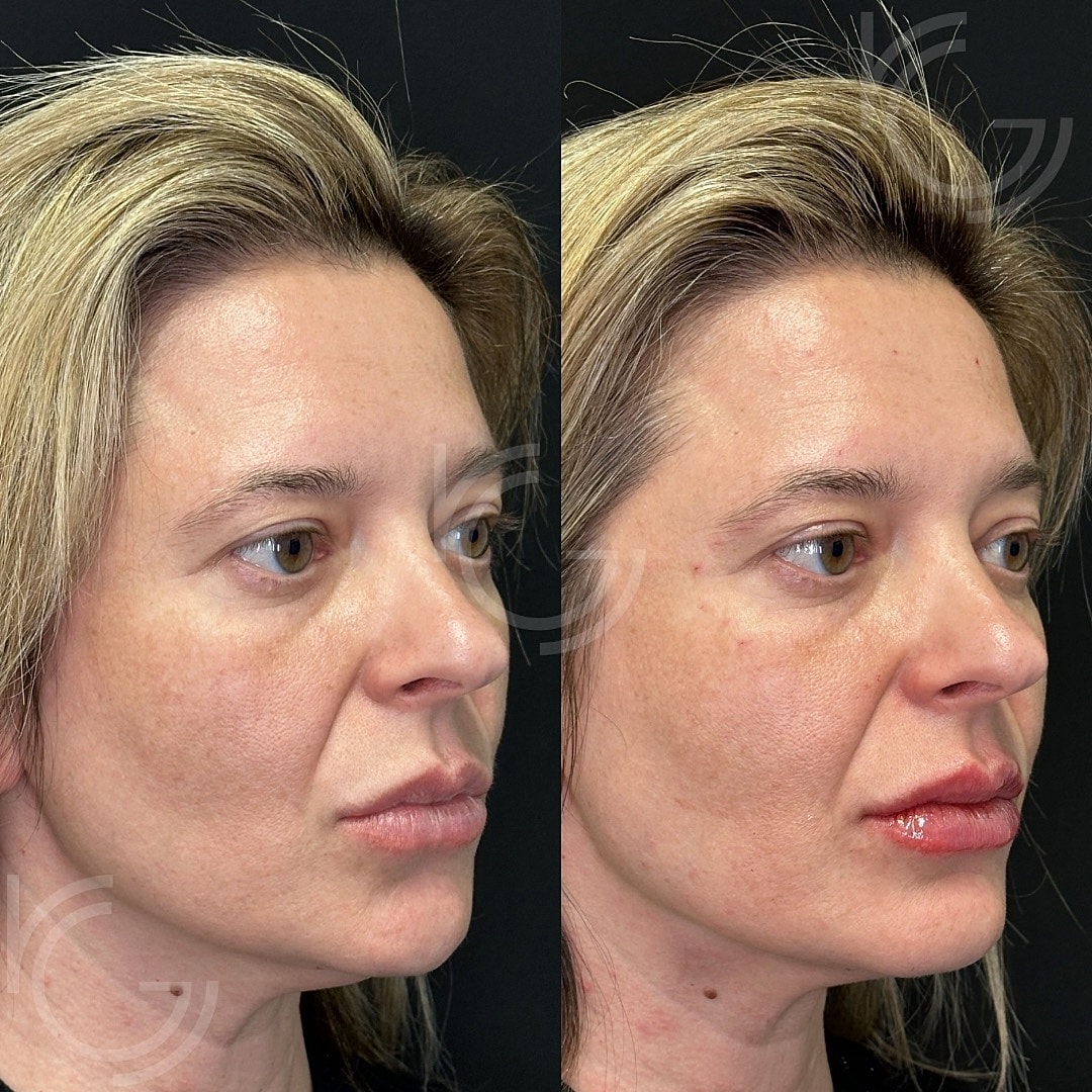 Lip Fillers Before & After