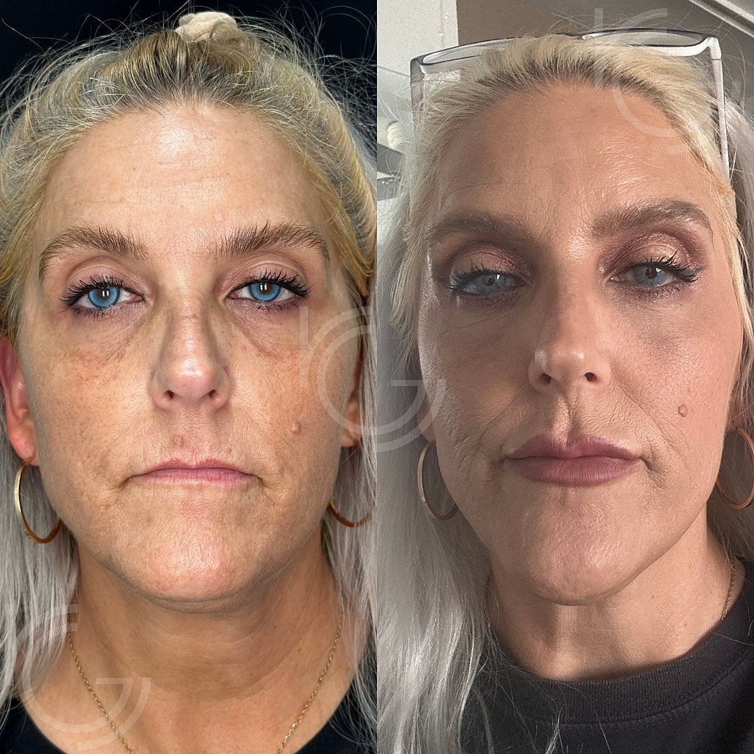 Lip Fillers Before & After