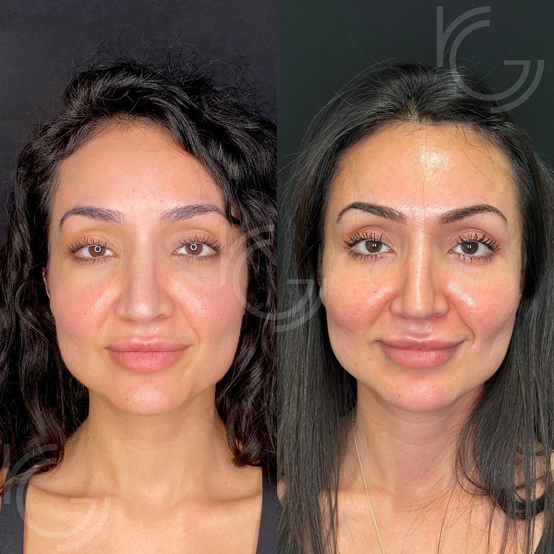 Sculptra Before & After