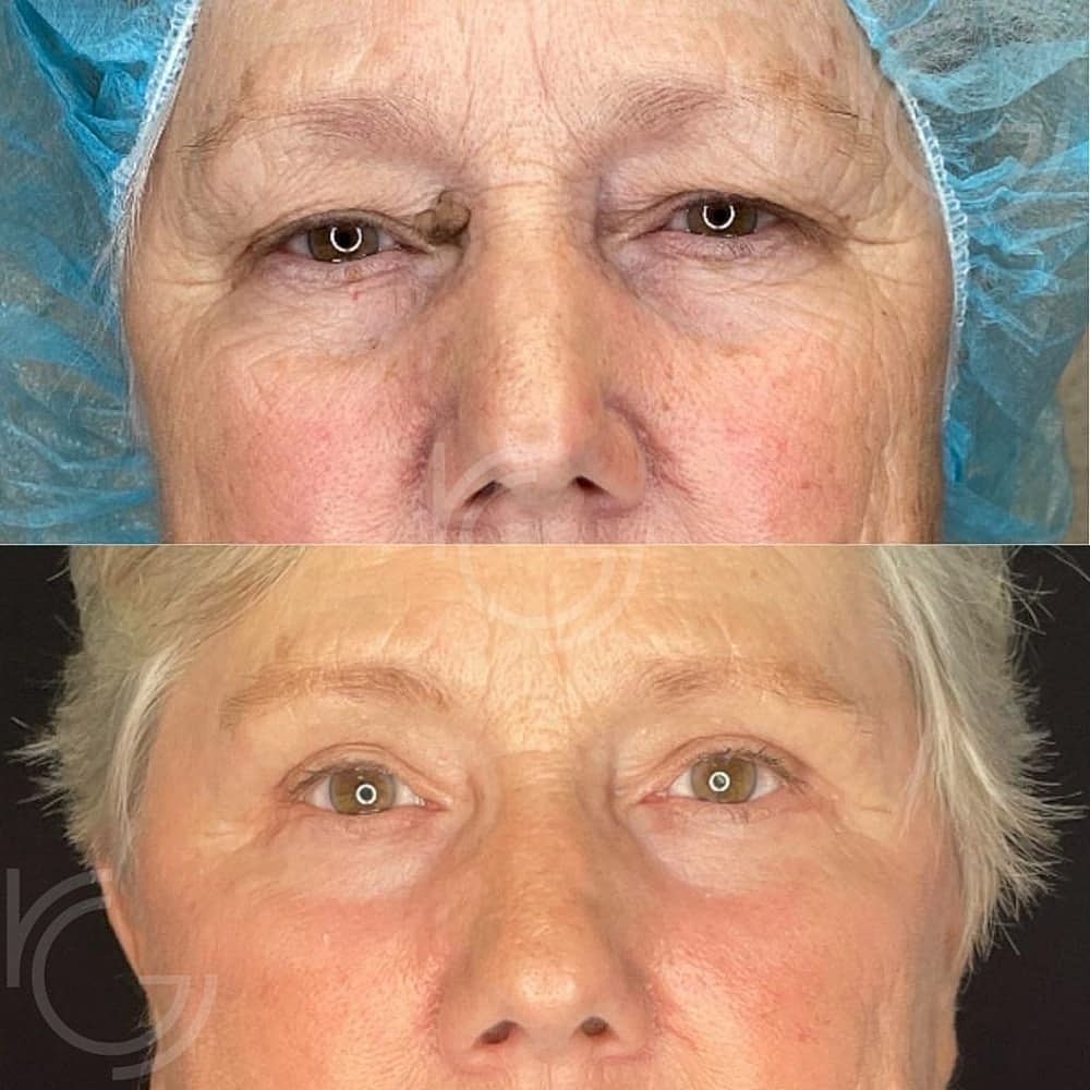 Upper Eyelid Surgery Before & After