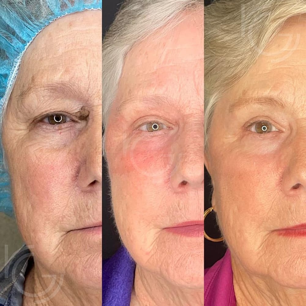 Upper Eyelid Surgery Before & After