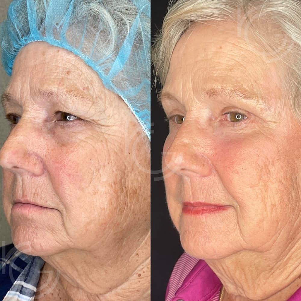 Upper Eyelid Surgery Before & After