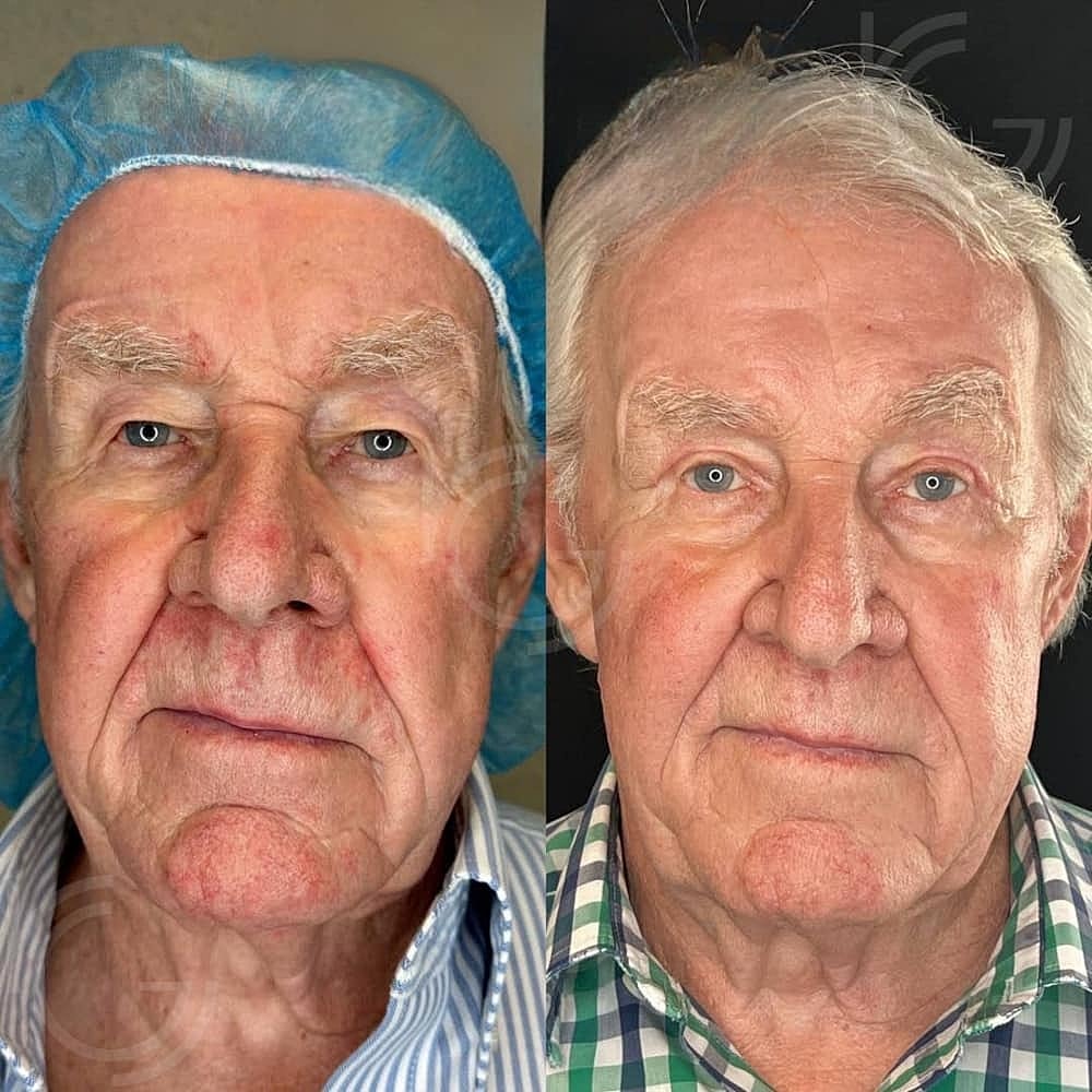 Upper Eyelid Surgery Before & After