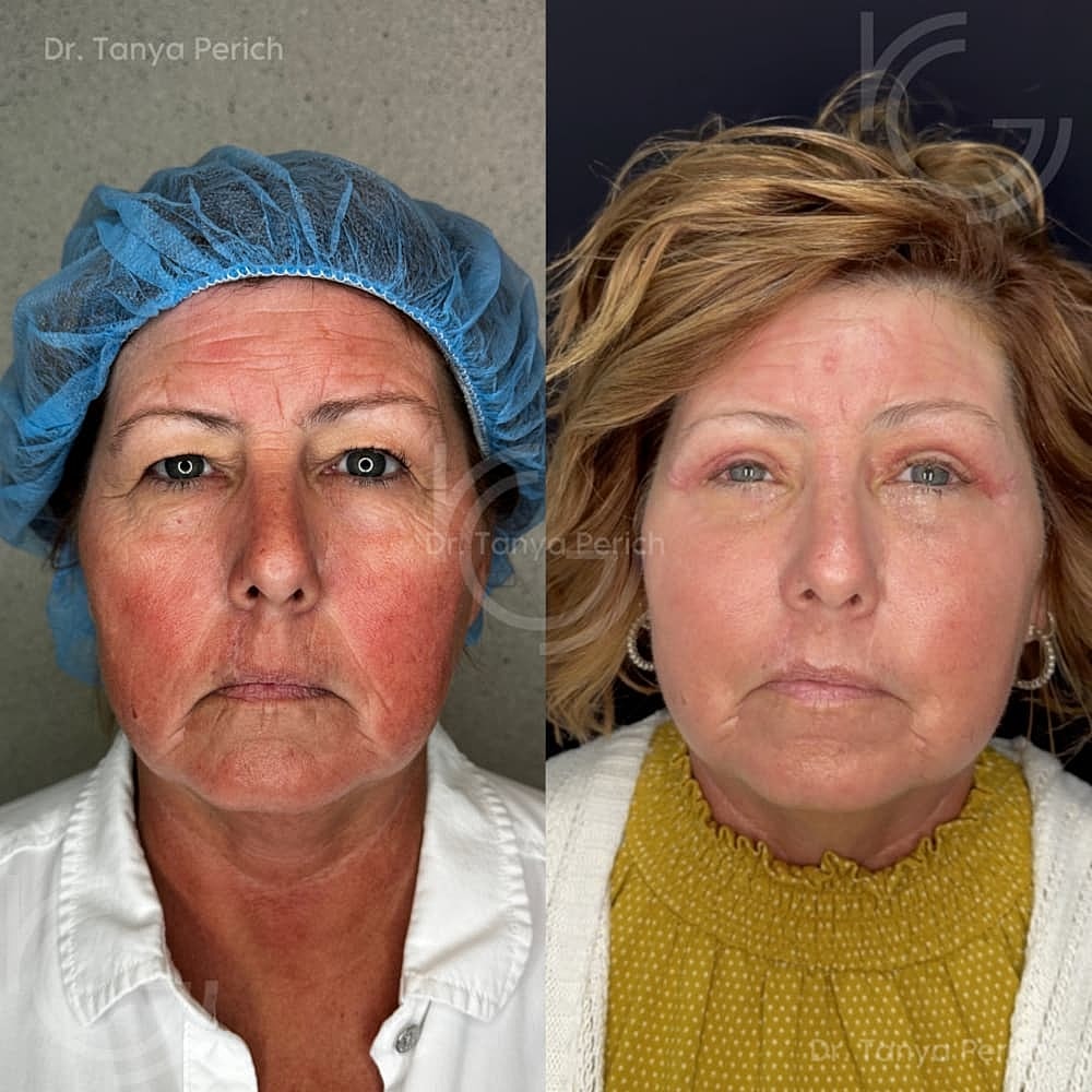 Upper Eyelid Surgery Before & After