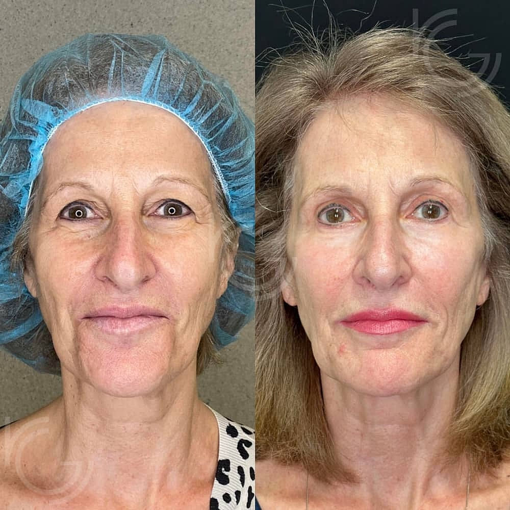 Upper Eyelid Surgery Before & After