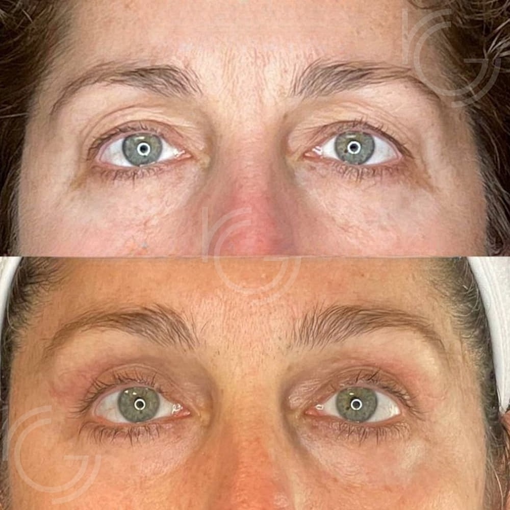 Upper Eyelid Surgery Before & After
