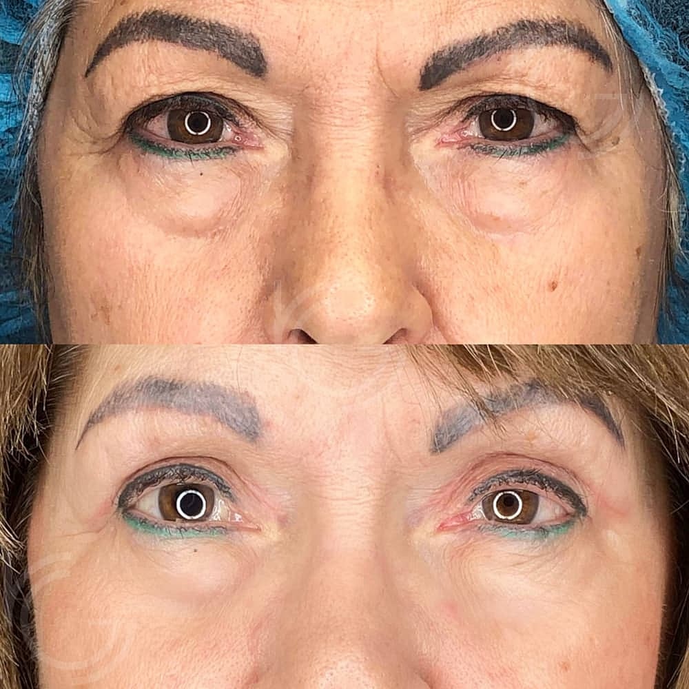 Upper Eyelid Surgery Before & After