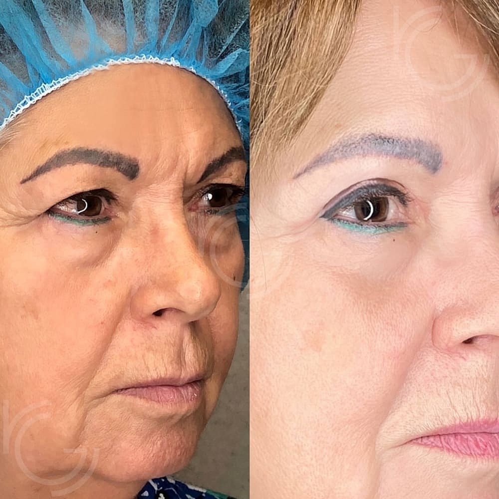 Upper Eyelid Surgery Before & After