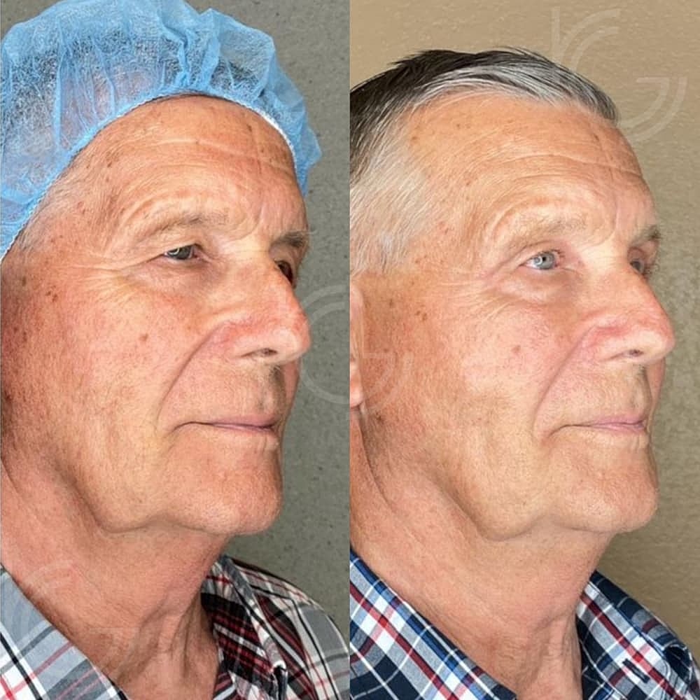 Upper Eyelid Surgery Before & After