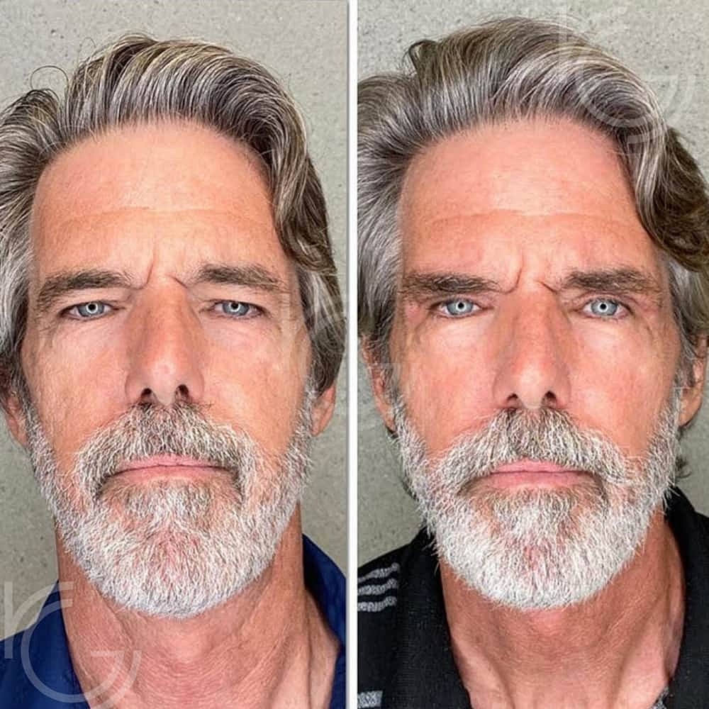 Upper Eyelid Surgery Before & After