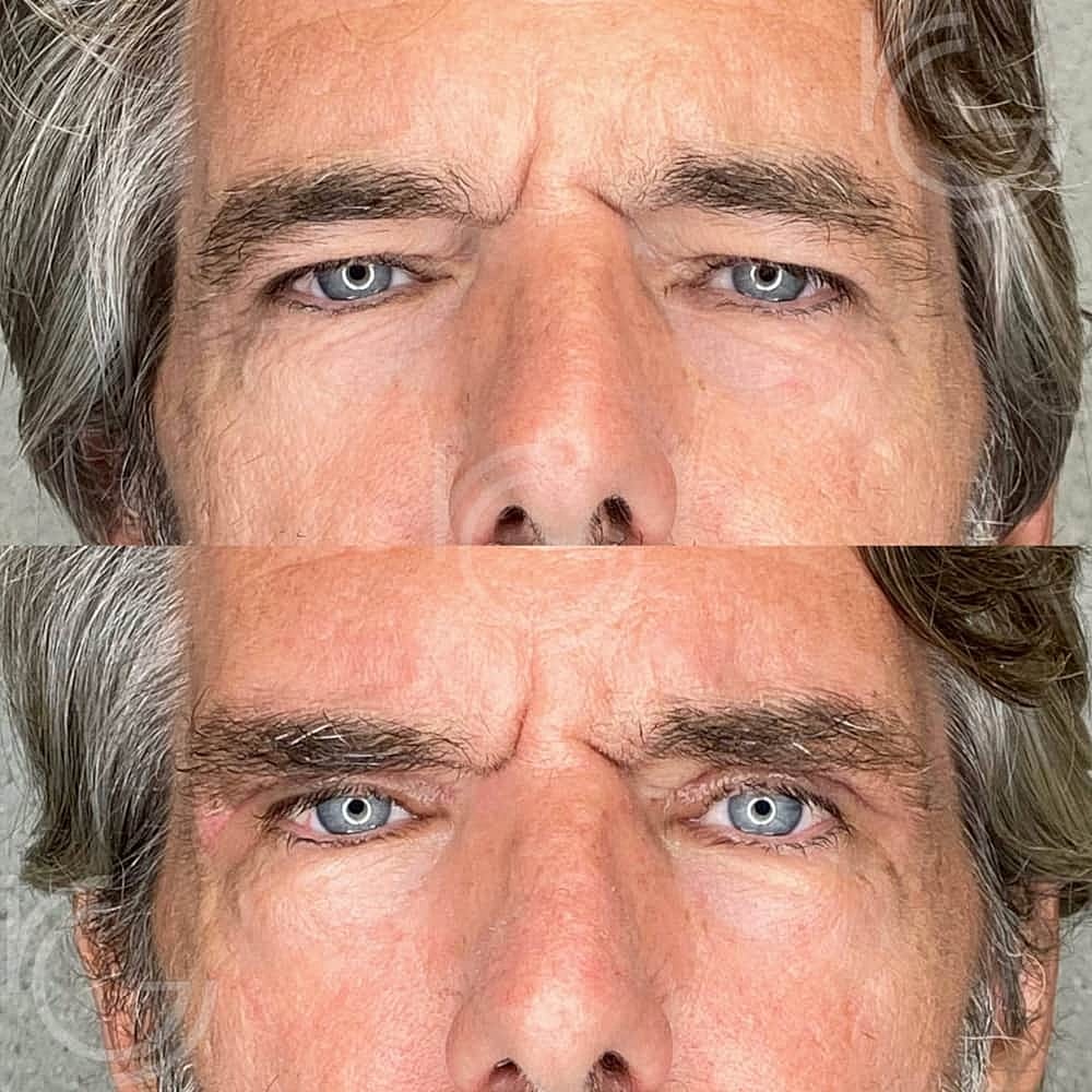 Upper Eyelid Surgery Before & After