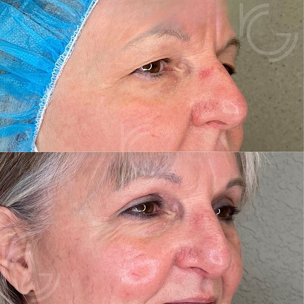 Upper Eyelid Surgery Before & After