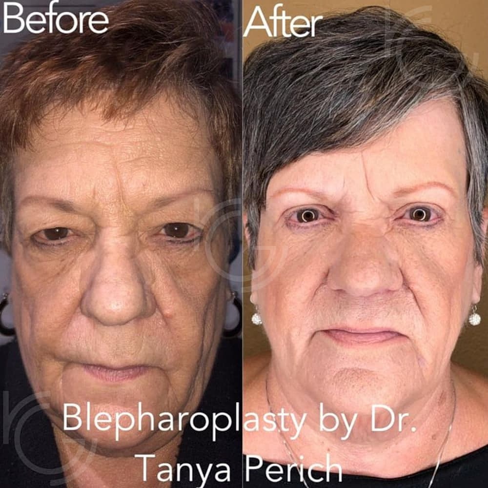 Upper Eyelid Surgery Before & After