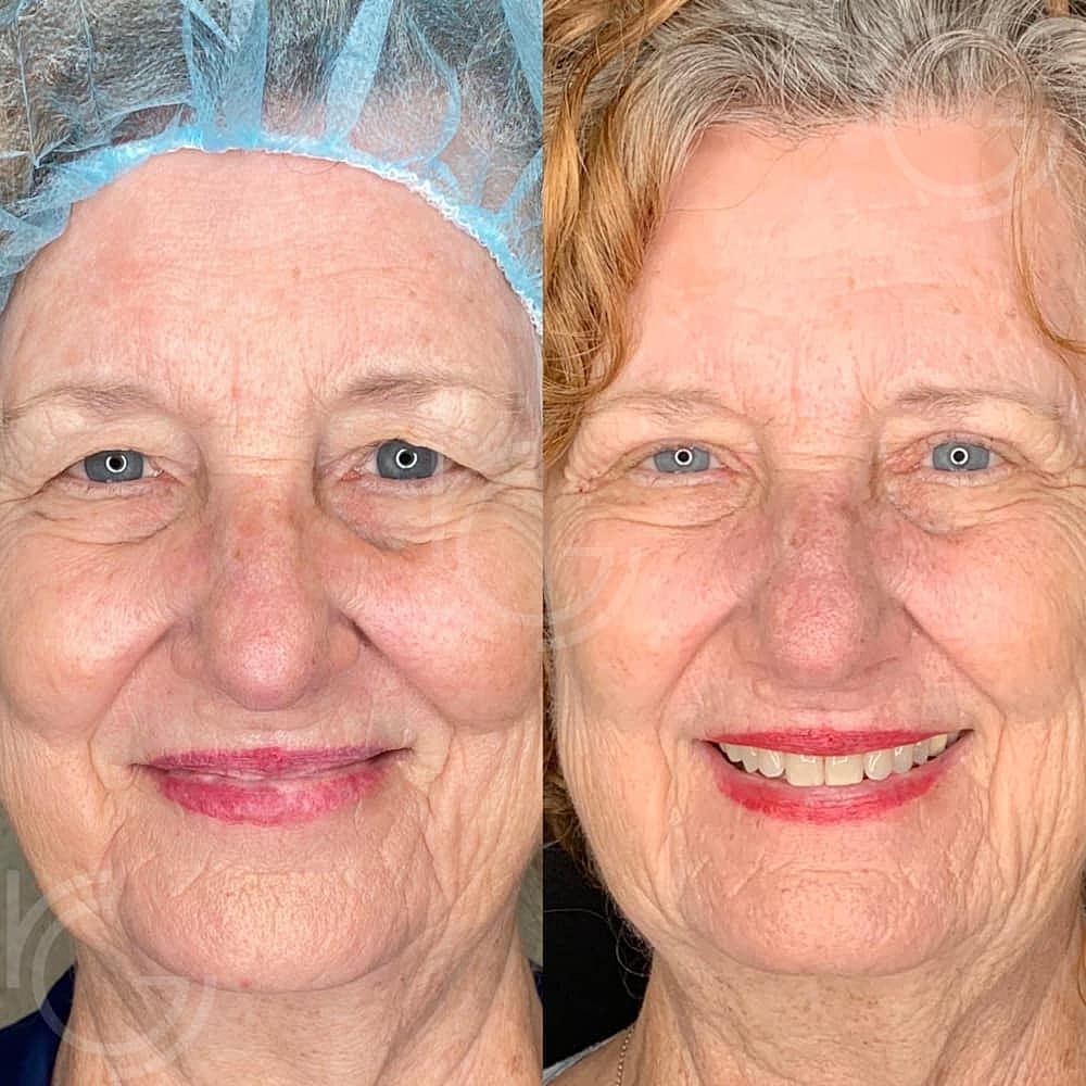 Upper Eyelid Surgery Before & After