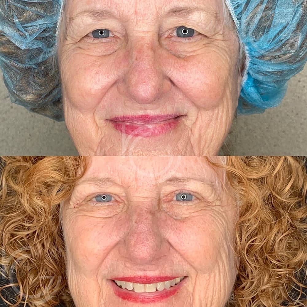 Upper Eyelid Surgery Before & After