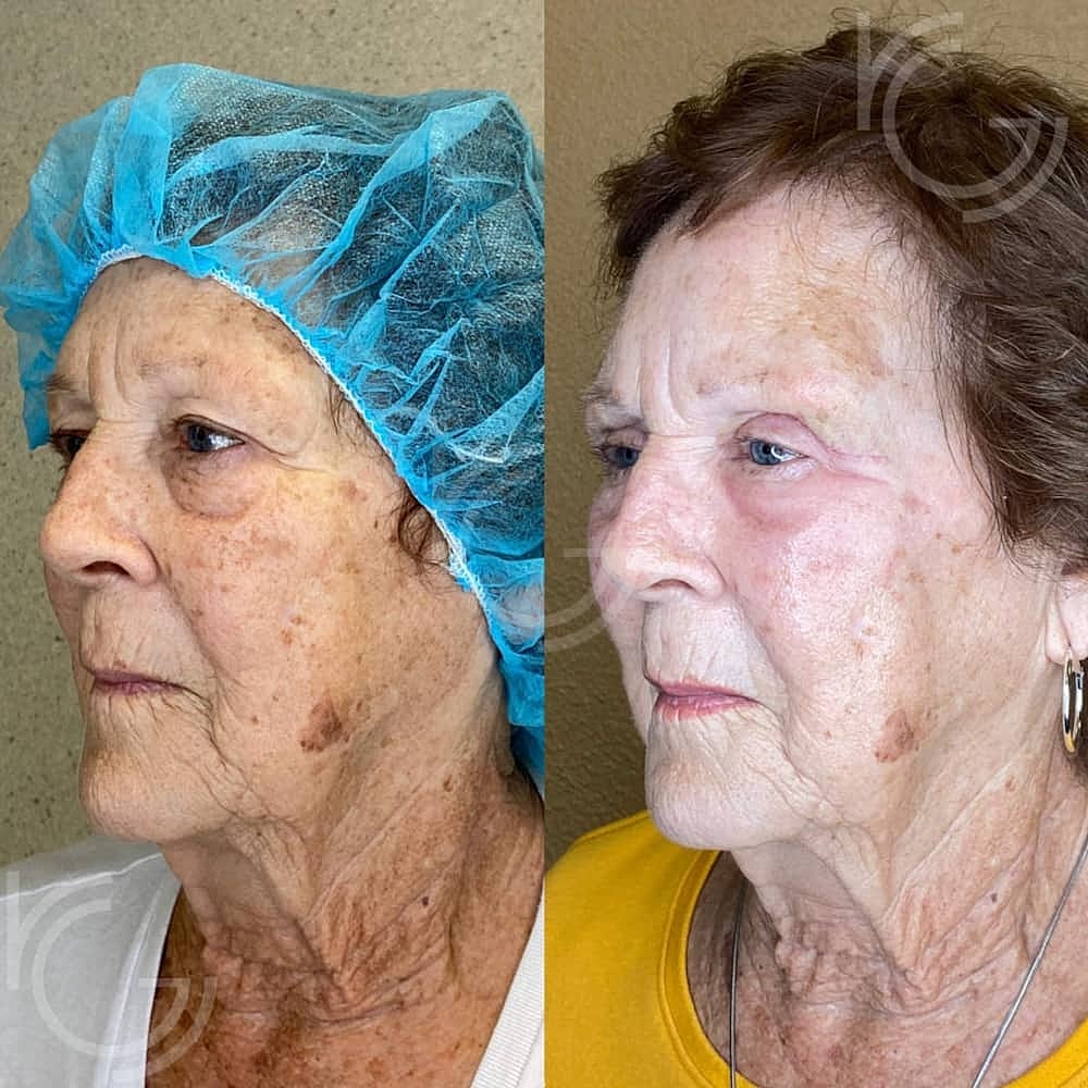 Upper Eyelid Surgery Before & After