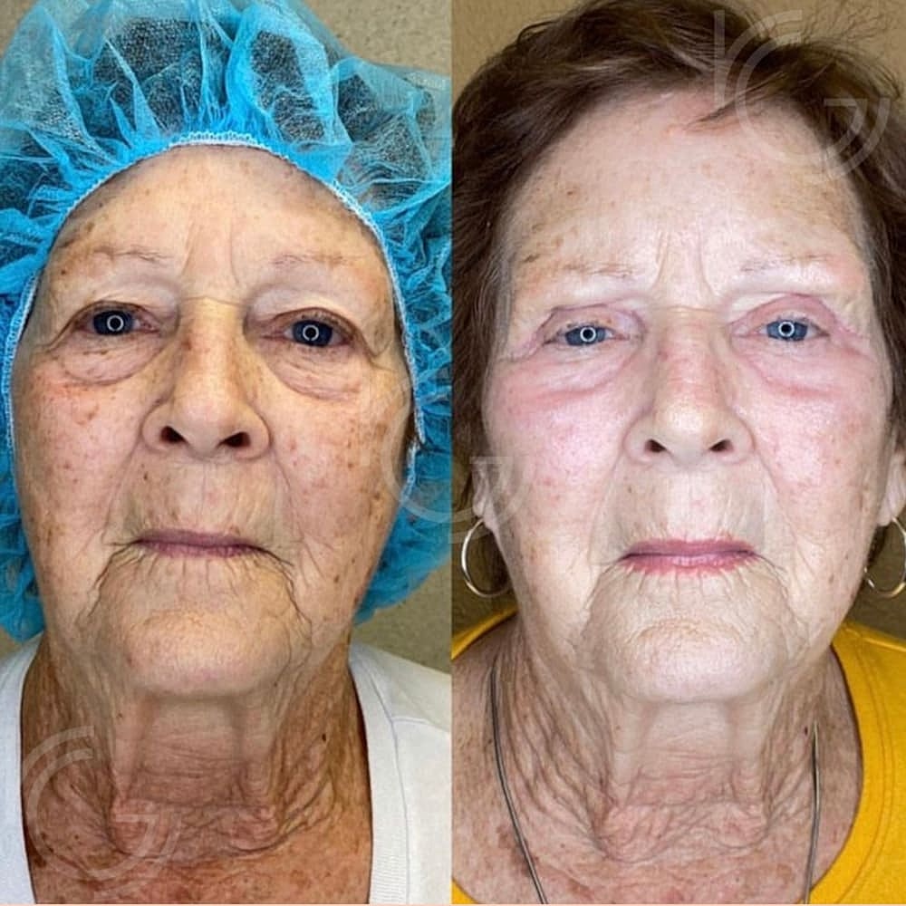 Upper Eyelid Surgery Before & After