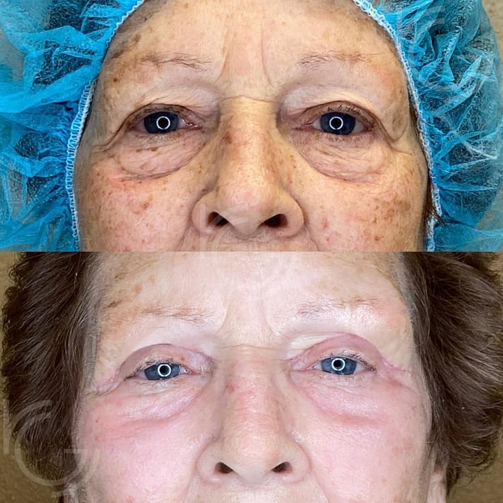 Upper Eyelid Surgery Before & After