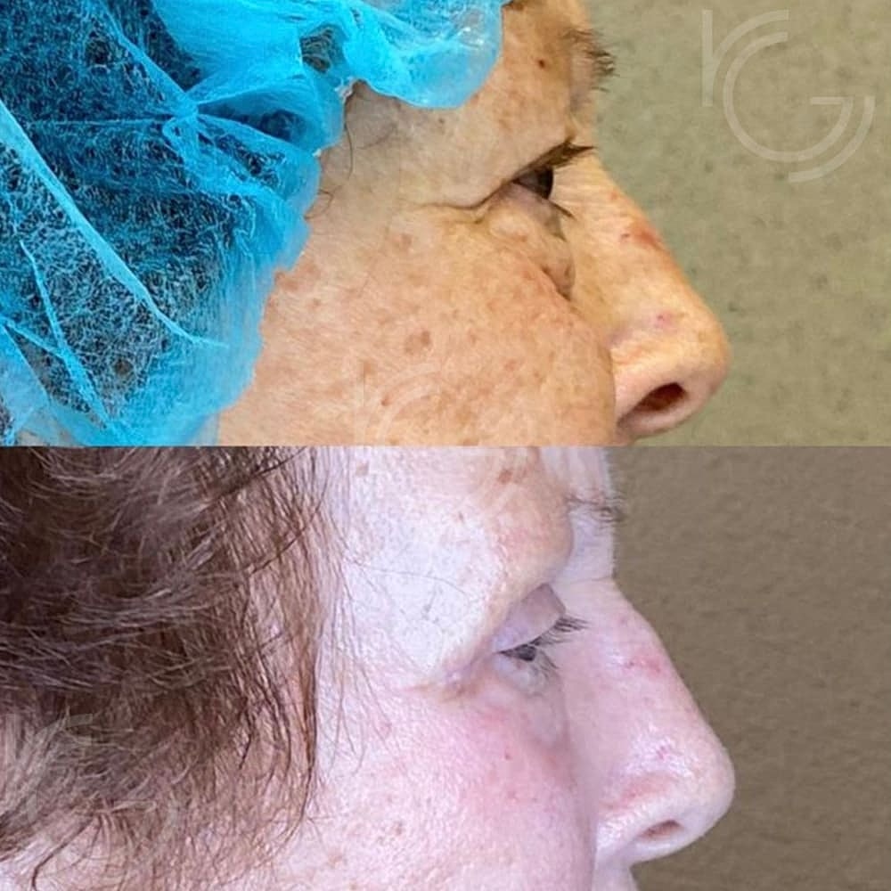 Upper Eyelid Surgery Before & After