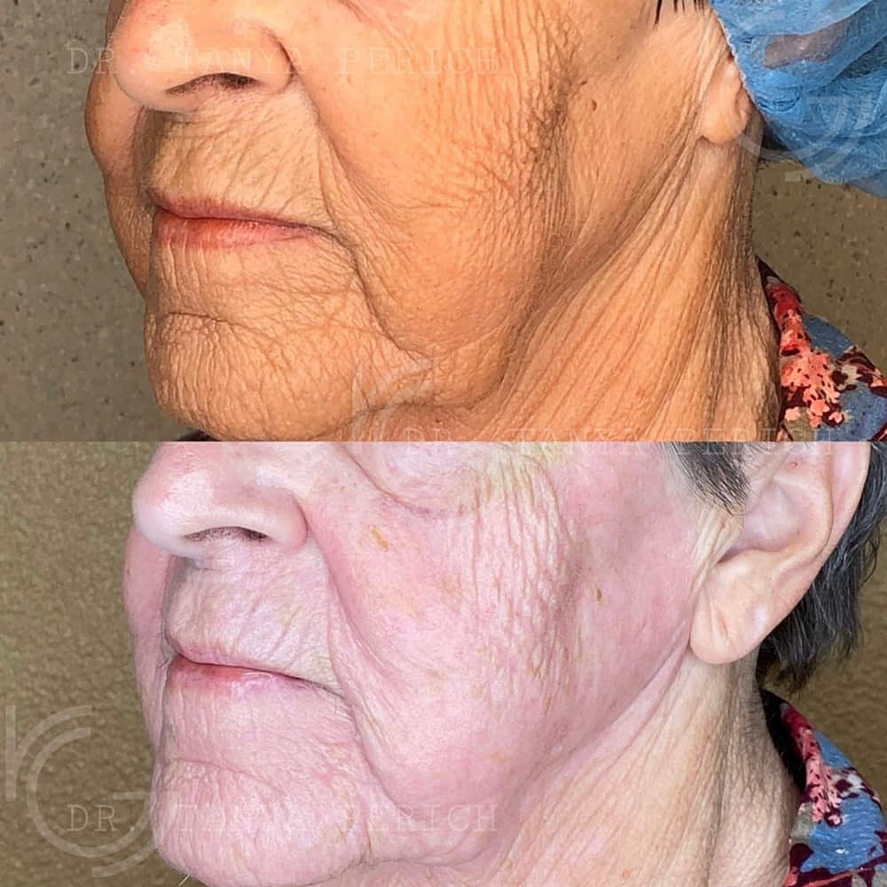 Upper Eyelid Surgery Before & After