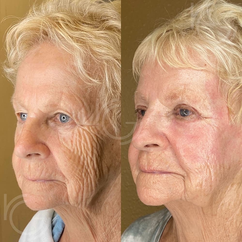 Upper Eyelid Surgery Before & After
