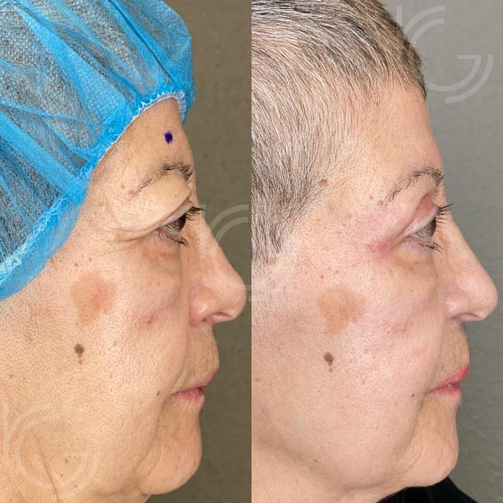 Upper Eyelid Surgery Before & After