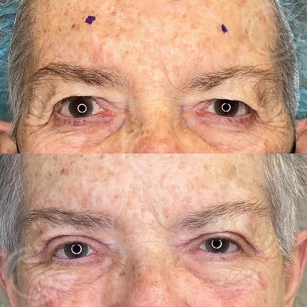 Upper Eyelid Surgery Before & After