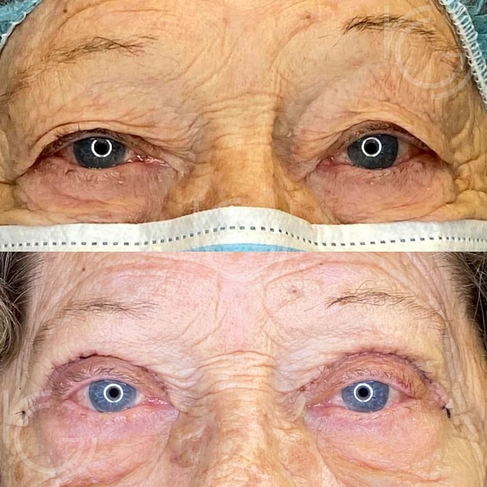Upper Eyelid Surgery Before & After