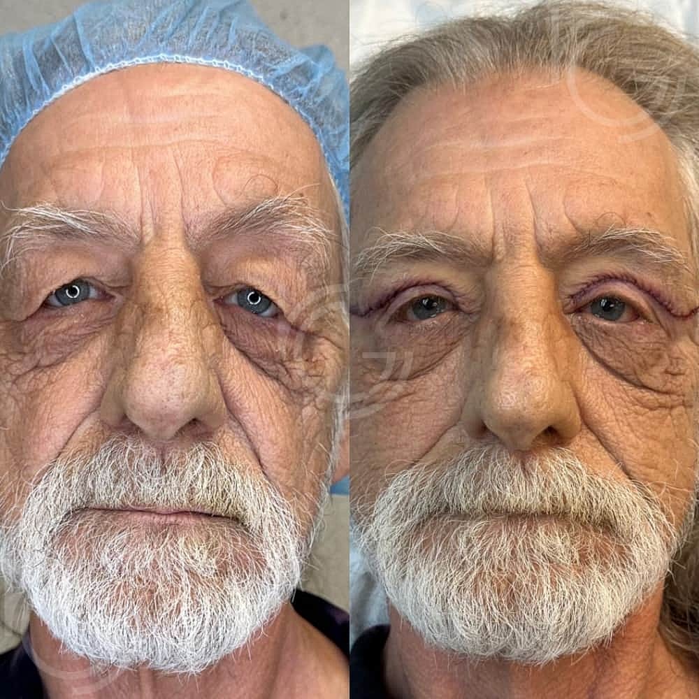 Upper Eyelid Surgery Before & After