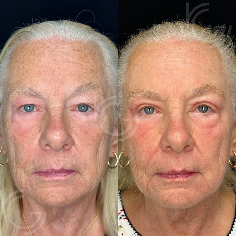 Upper Eyelid Surgery Before & After