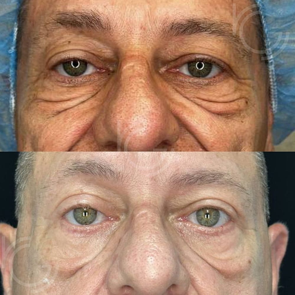 Upper Eyelid Surgery Before & After