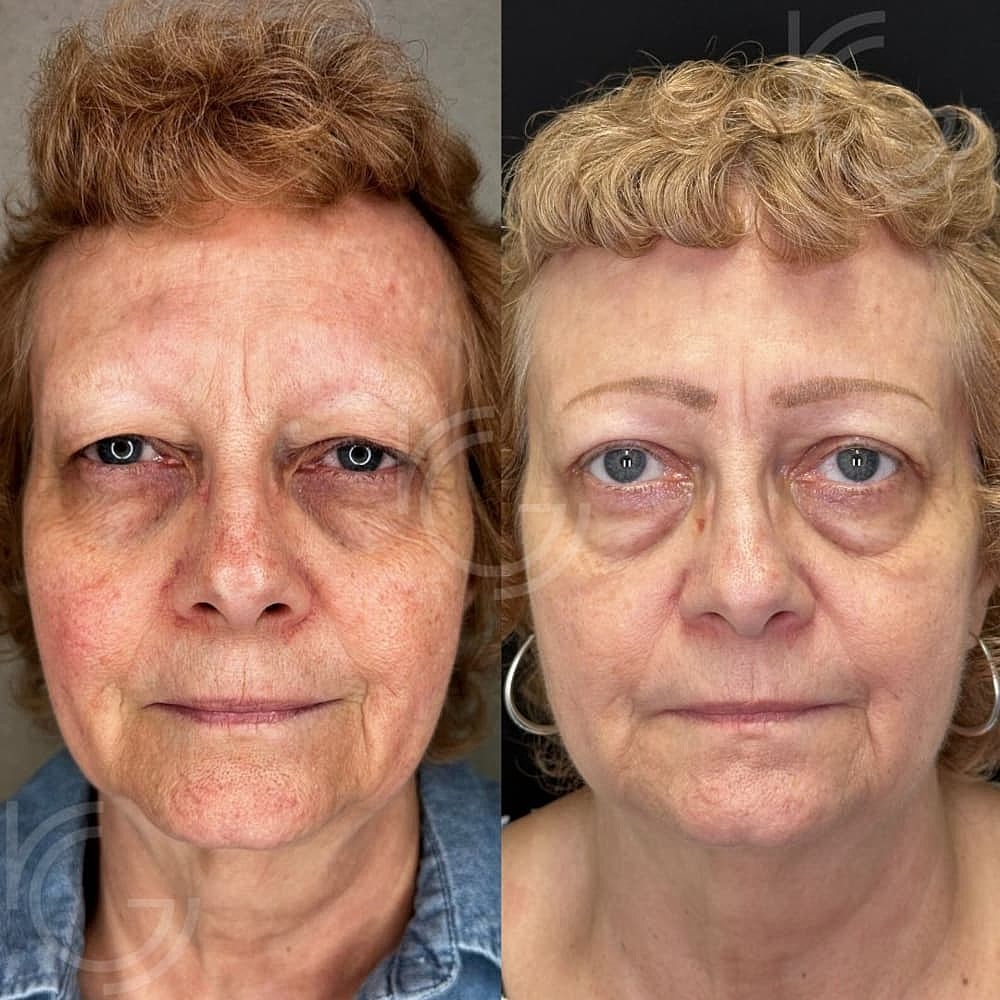 Upper Eyelid Surgery Before & After