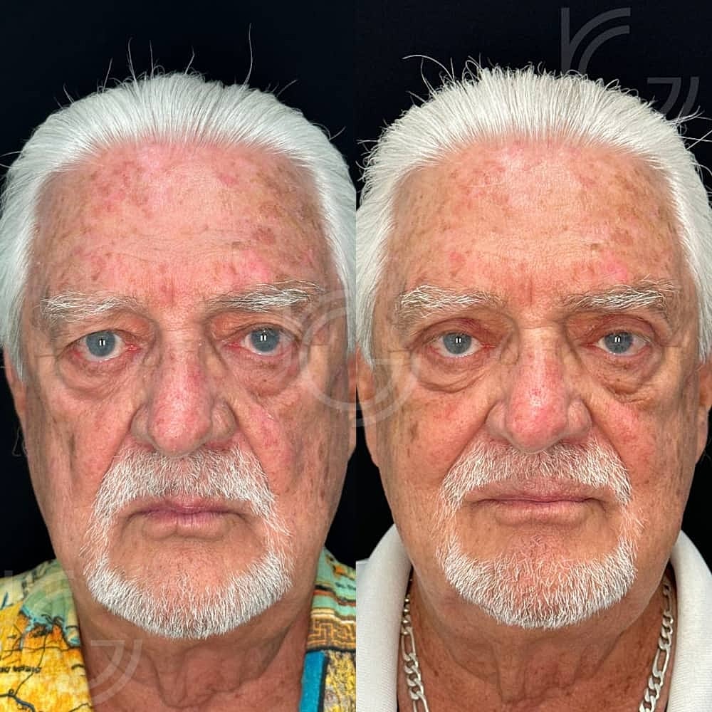 Upper Eyelid Surgery Before & After