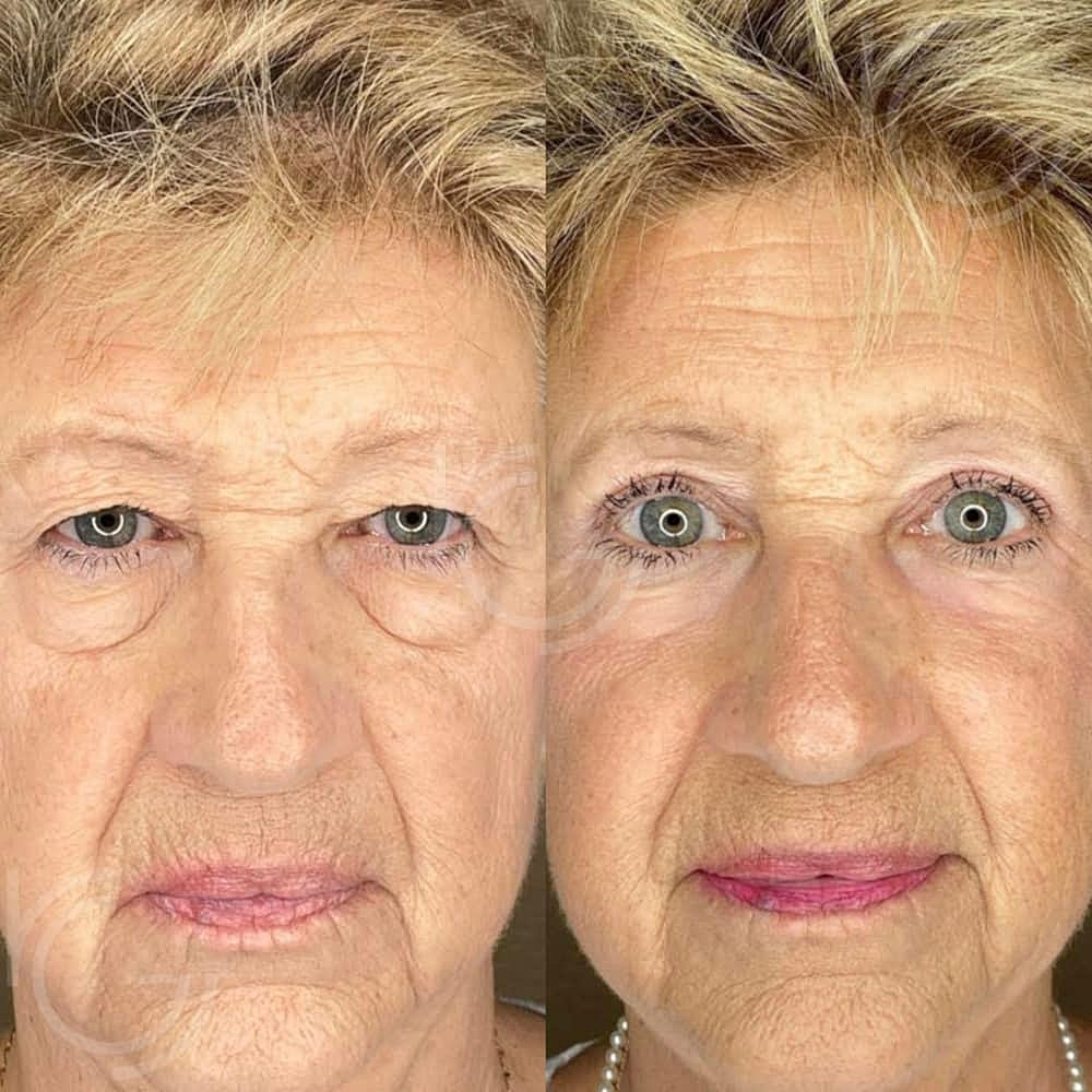 Lower Eyelid Surgery Before & After