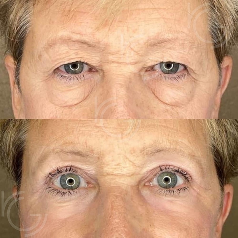 Lower Eyelid Surgery Before & After