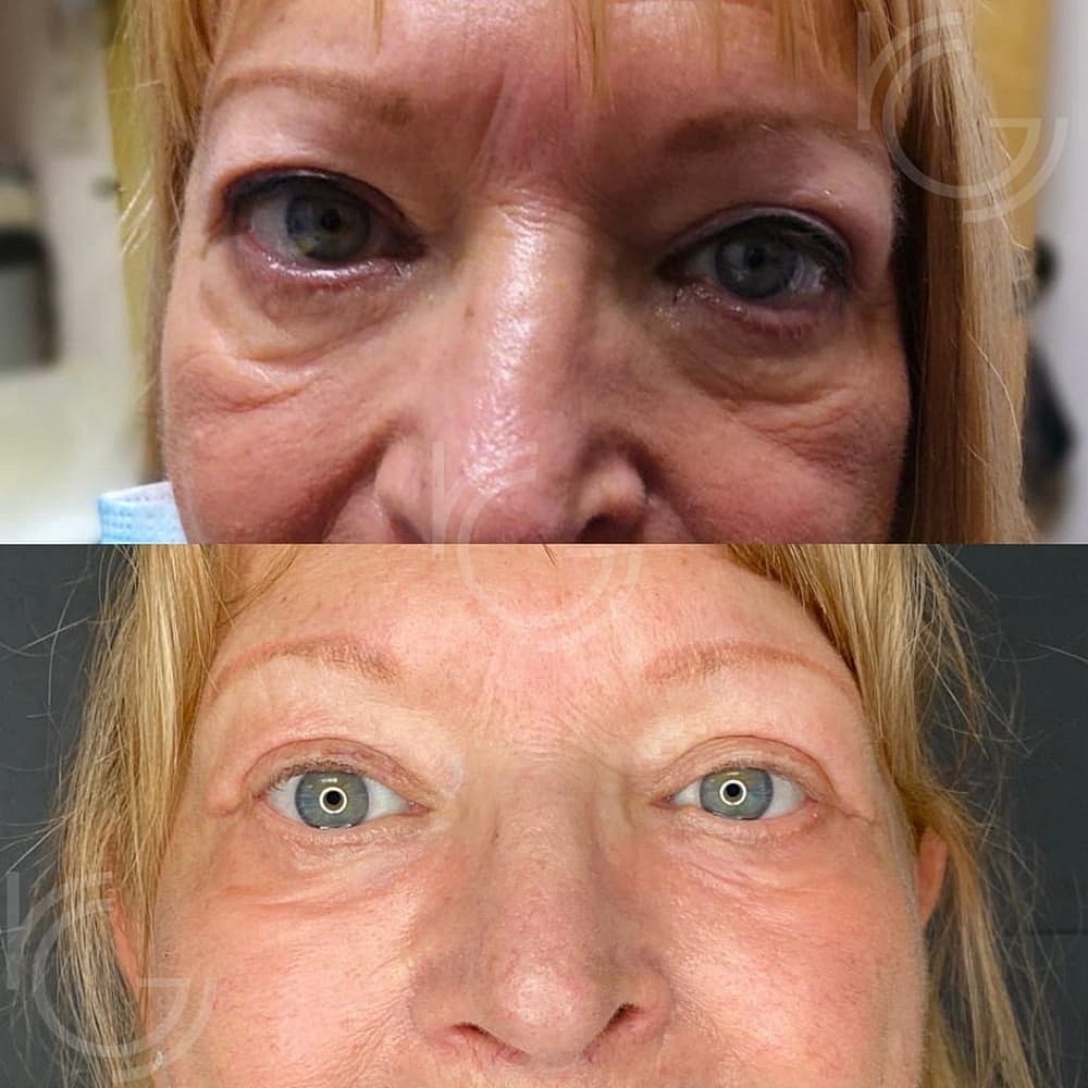 Lower Eyelid Surgery Before & After