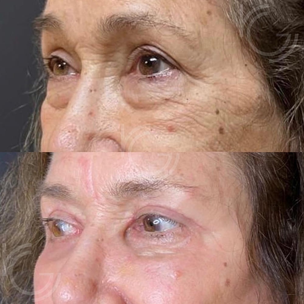Lower Eyelid Surgery Before & After